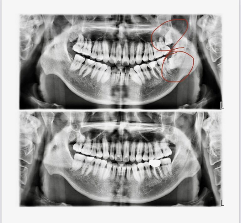 wisdom teeth removal x-ray picture