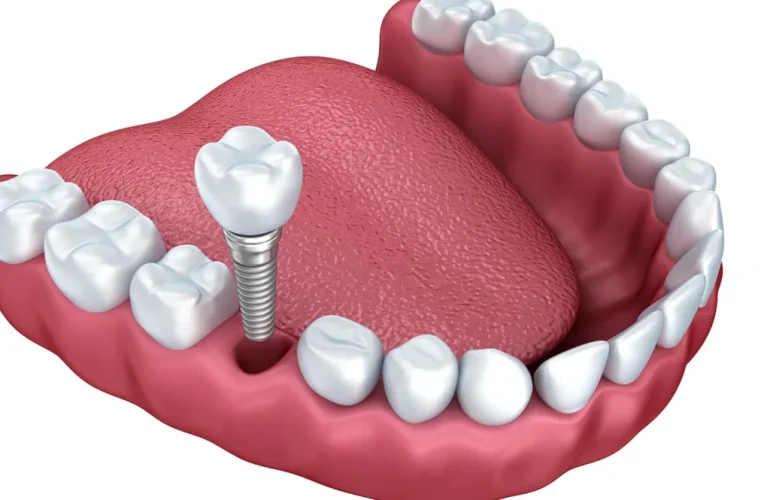 Dental Implants Scarborough