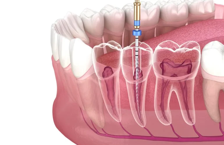 Root Canal Treatment in Scarborough
