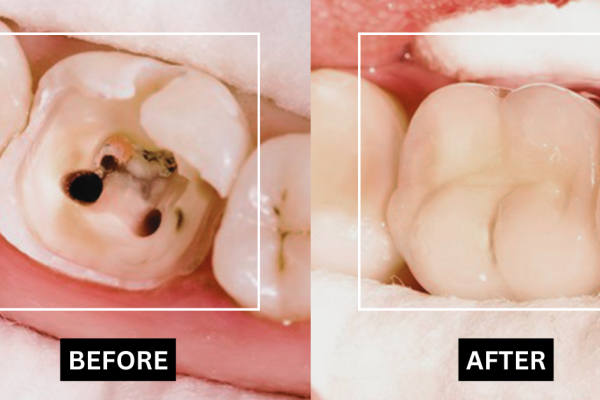 Root Canal before and after photo