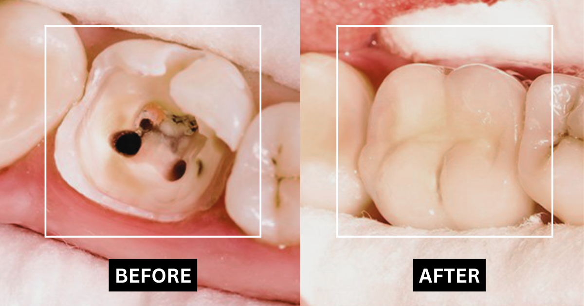 Root Canal before and after photo