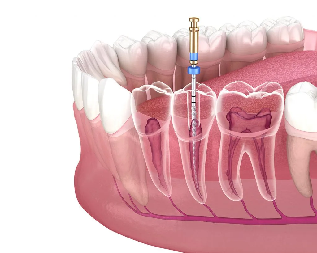 Root Canal Treatment in Scarborough